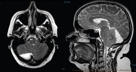 retrocerebellar cyst symptoms.